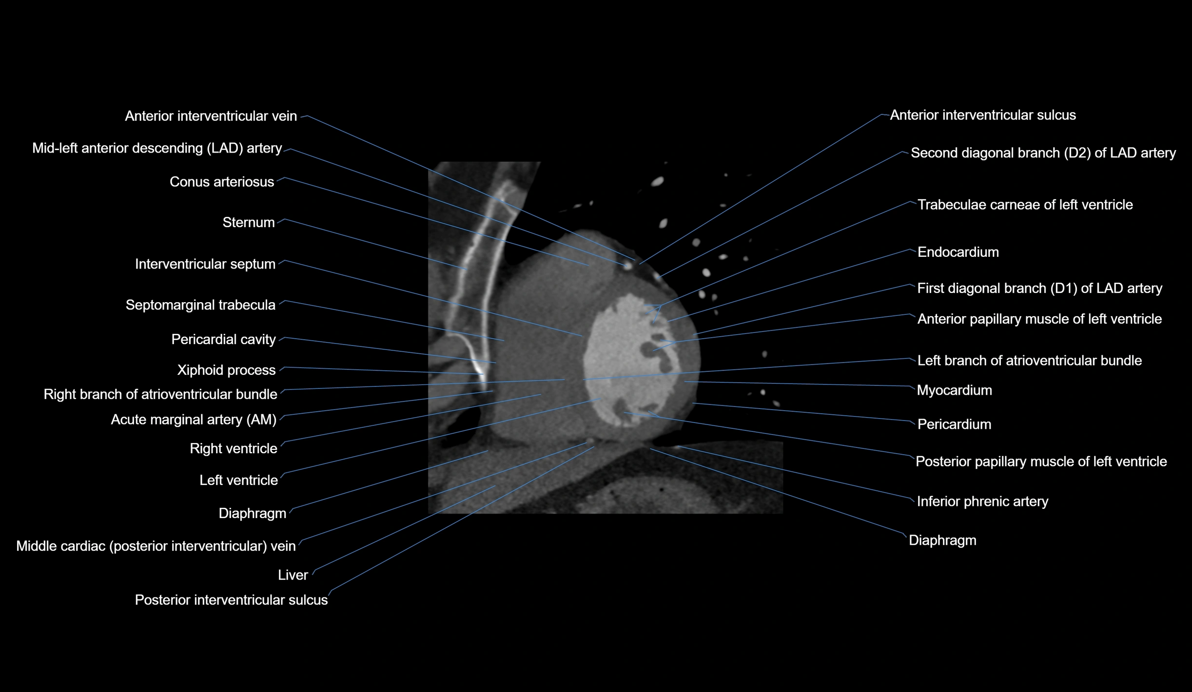 CT heart (coronary angiogram) short axis view  cross sectional anatomy labelled radiology image-00034.webp
